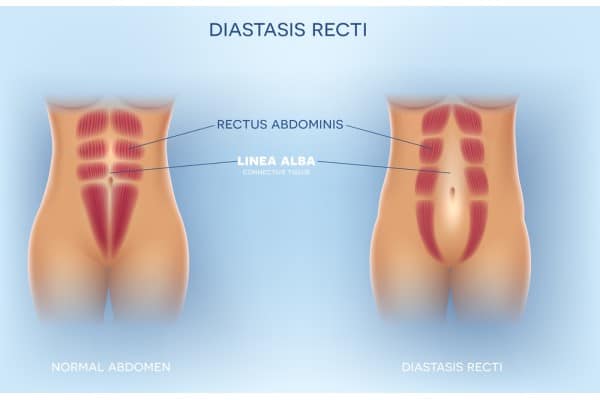 What Non-Surgical Options Are Available for Diastasis Recti Brackley?