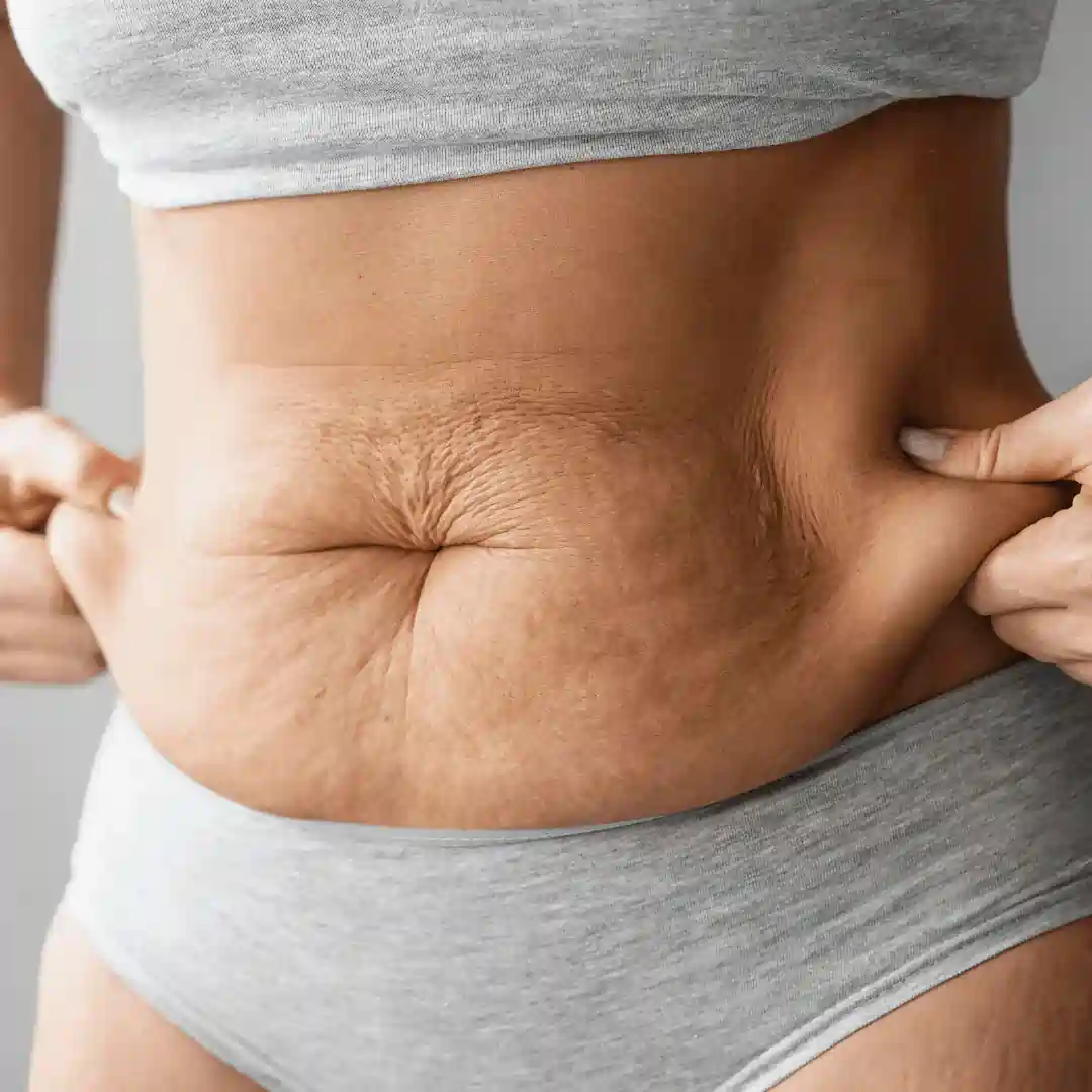 Is It Normal to Have Loose Skin After Pregnancy Brackley?