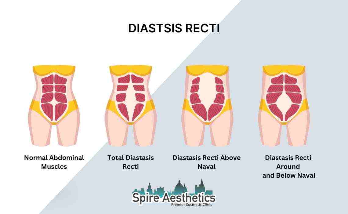 Is Non-Surgical Diastasis Recti Treatment Right for You? Common Concerns Answered Brackley